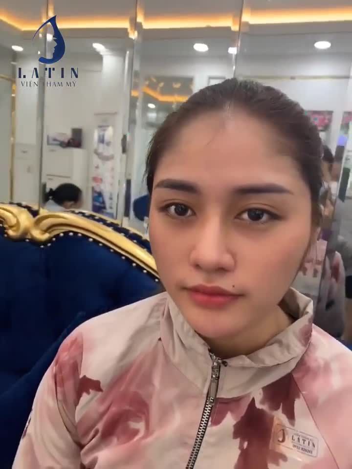 MŨI CẤU TRÚC 6 THÁNG QUÁ XINH