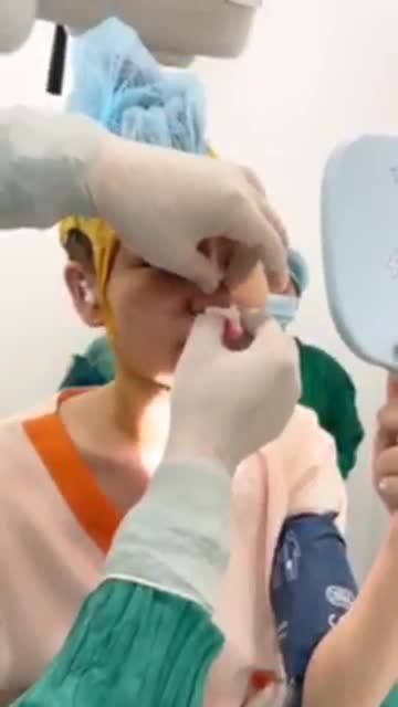 XEM DÁNG MŨI TRƯỚC KHI ĐÓNG VẾT KHÂU, KHÁCH HÀNG KHÔNG ĐAU GÌ TRONG QUÁ TRÌNH PHẪU THUẬT