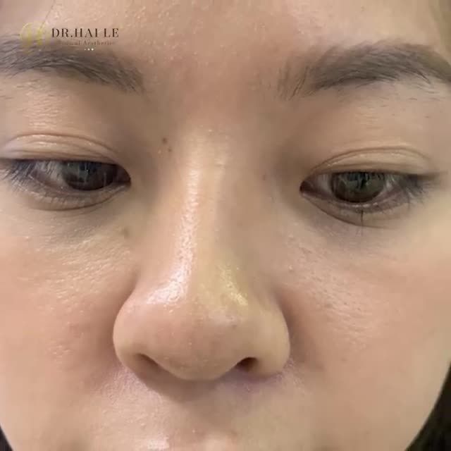 TUYẾT LINH kể về quá trình đi cắt mí của cô ấy. Còn bạn, bạn có sẵn sàng chia sẻ về hành trình đi CẮT MÍ THẨM MỸ của mình.