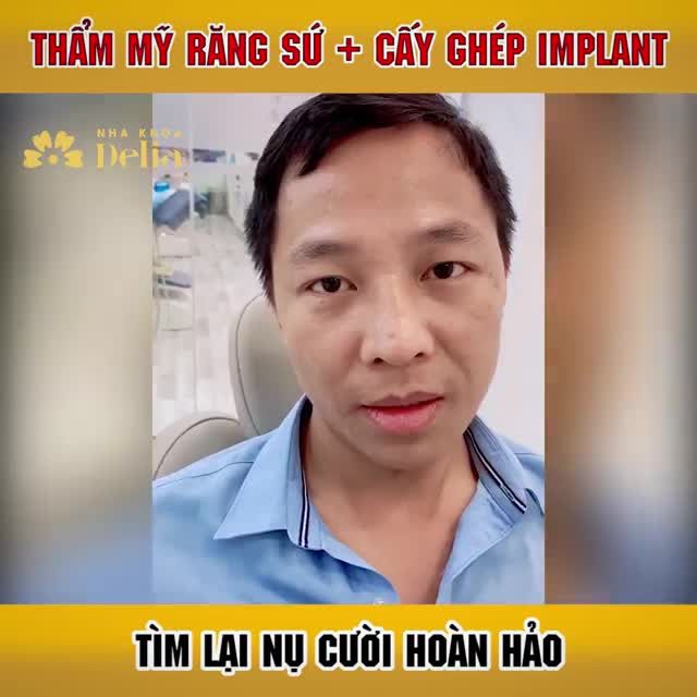 Thẩm mỹ 26 răng sứ Emax + Cấy ghép 3 trụ Implant Straumann giúp KH tìm lại nụ cười hoàn hảo