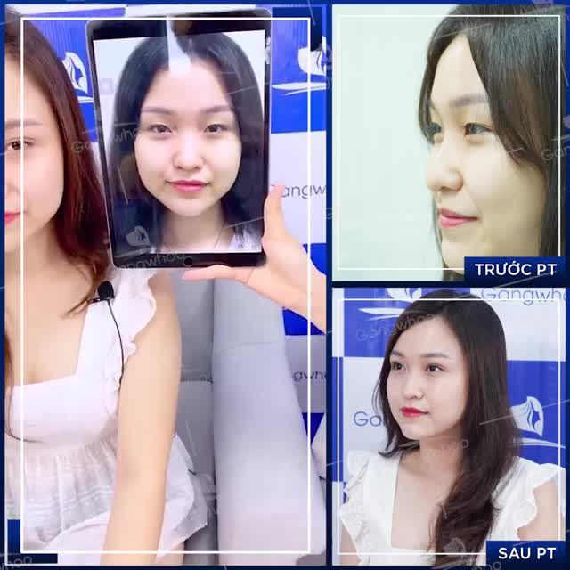 COMBO BẤM MÍ VĨNH VIỄN, MỞ GÓC MẮT TRONG LẤY LẠI TỰ TIN CHO CÔ NÀNG SINH VIÊN NĂM NHẤT