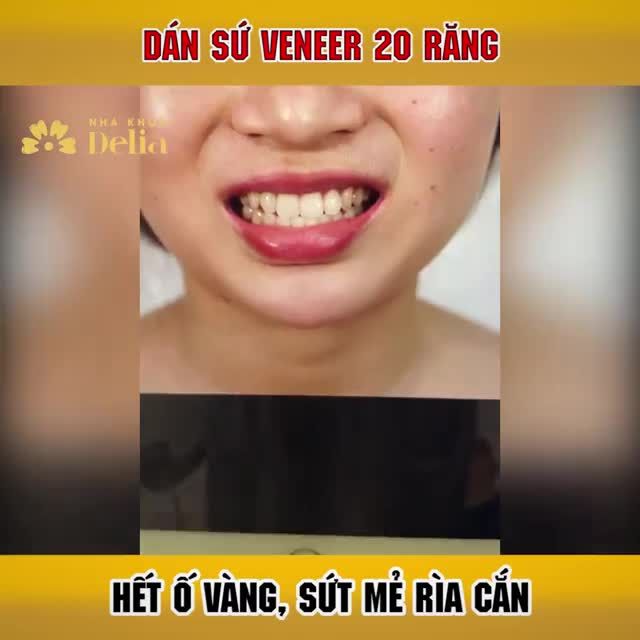 Dán veneer 20 răng sứ giải cứu RĂNG Ố VÀNG, SỨT MẺ RÌA CẮN