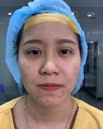 Đẹp siêu cấp cùng phương pháp Cắt mí “khó độ 1” + Kết hợp chuyển mỡ  Trọn vẹn sau 45 phút