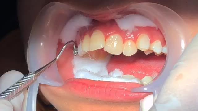 Gắn mắc cài cho khách hàng răng HÔ - KHẤP KHỂNH NẶNG CẢ 2 HÀM