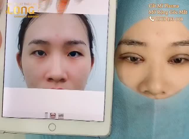 Cắt mí mắt để tạo mắt 2 mí là việc tất nhiên. Nhưng với những đôi mắt khó thì cắt mắt không thôi vẫn chưa đáp ứng được việc hoàn thiện đôi mắt.