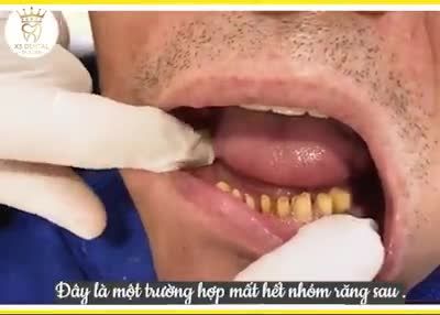 NGƯỜI CAO TUỔI BỊ MẤT NHIỀU RĂNG HOẶC TOÀN HÀM