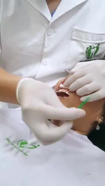 Quá trình dán sứ Veneer cho KH Nguyễn Ngọc Hoa