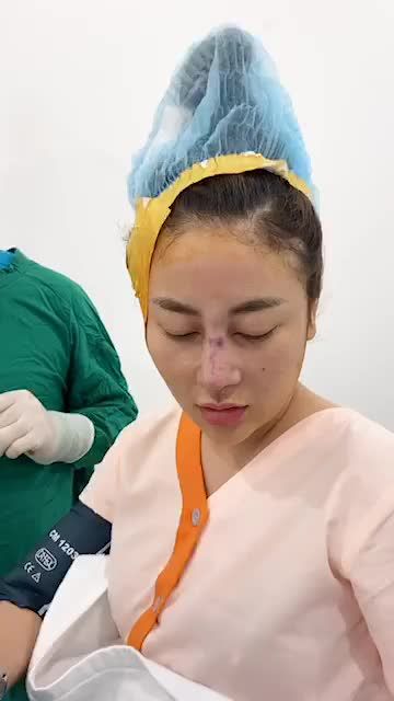 Sửa mũi hỏng do nâng mũi bằng sụn nhân tạo