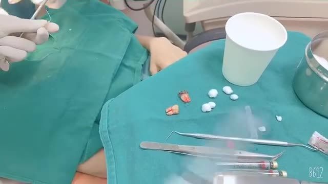 TẠM BIỆT CẶP RĂNG LỆCH CHỈ SAU 3 PHÚT