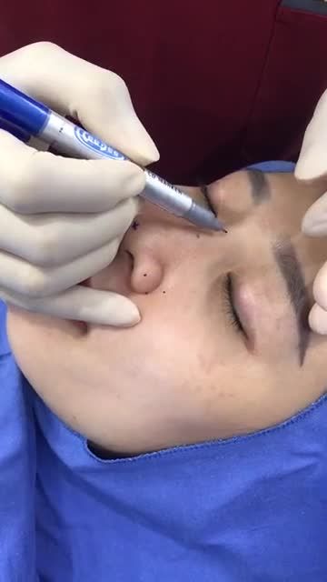 Phân tích Nâng mũi+ Cuộn cánh mũi thay đổi phong thuỷ gương mặt cho khách hàng