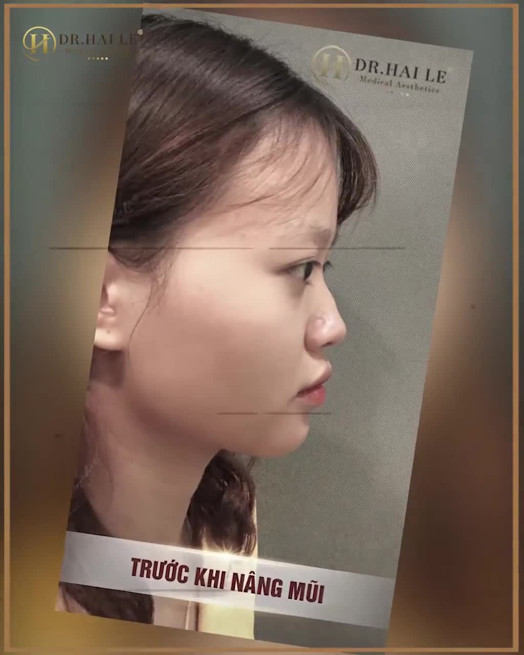 BẠN CÓ PHẢI LÀ CÔ GÁI YÊU THÍCH CHIẾC MŨI "CAO, THANH TÚ"?  NẾU CÓ THÌ KHÔNG THỂ BỎ QUA VIDEO NÀY RỒI!