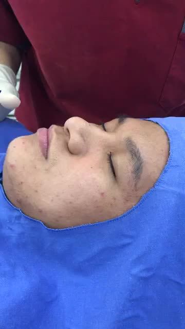 MŨI TO, MŨI GỒ phải làm sao? Cùng bác sĩ Kangnam chia sẻ bí kíp Thu nhỏ đầu mũi thay đổi diện mạo chỉ sau 30'