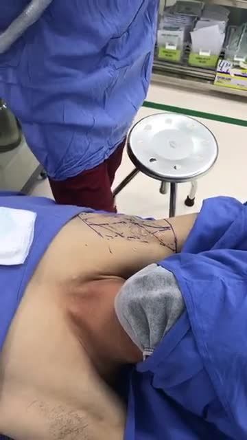 Công nghệ Laser chiếu sáng lộ tuyến - Hút bỏ nội soi tuyến mồ hôi nách EndoDry tại Bệnh viện Thẩm mỹ Kangnam