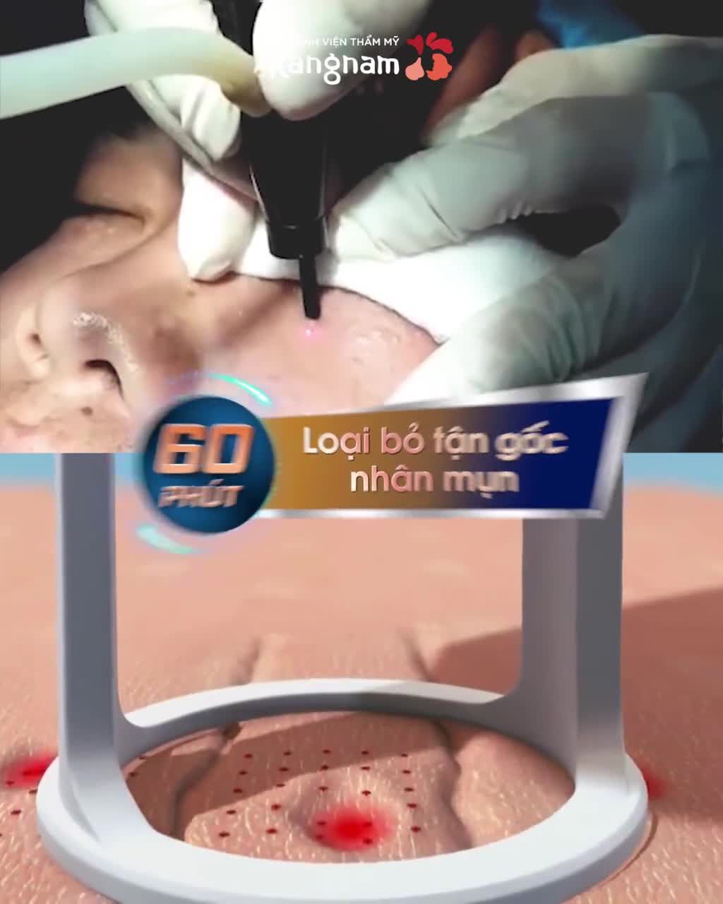 MỤN THỊT "SẦN SÙI" ở Mắt/ Má/ Trán/ Cổ?