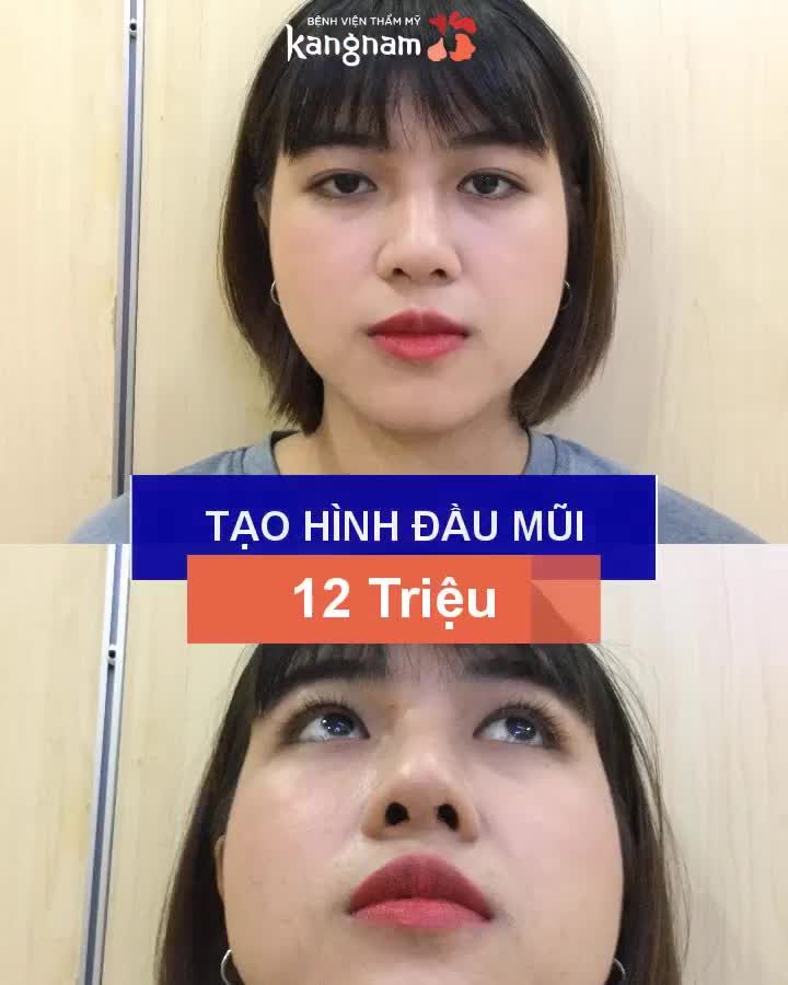 Chỉ từ 6 Triệu sở hữu MŨI ĐẸP NHƯ Ý