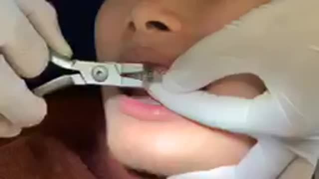 Bung lụa cho khách hàng răng khấp khểnh