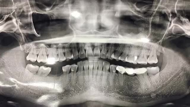 Cấy implant răng số 46 cho chị Trinh tại Nha Khoa Thuỳ Anh.