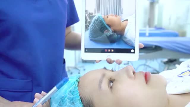 Dáng mũi đẹp ngay sau khi nâng của Dr Vũ Quang