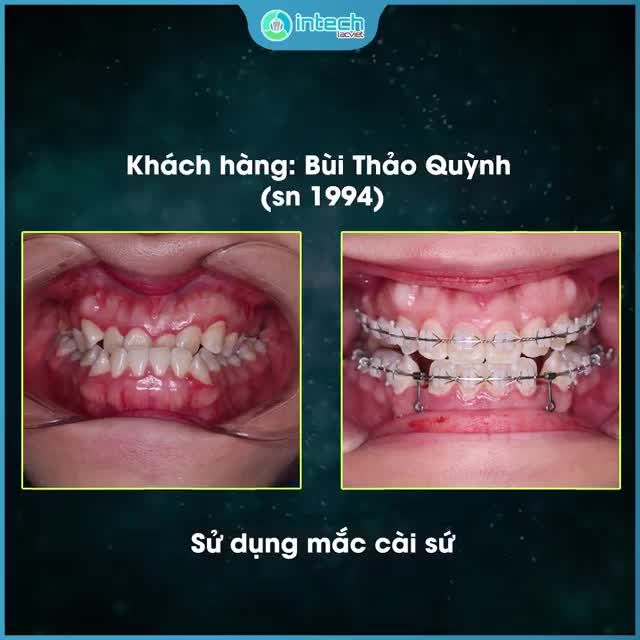 "ĐẬP TAN" MỌI KHUYẾT ĐIỂM CỦA NỤ CƯỜI