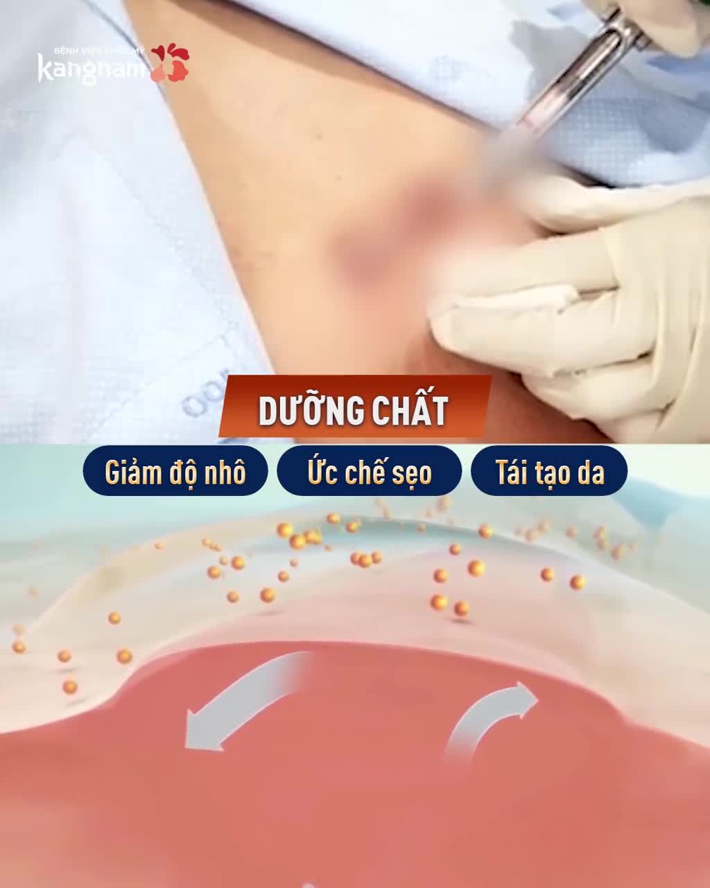 Sẹo lồi ngực - Sẹo bỏng - Sẹo lồi co kéo?