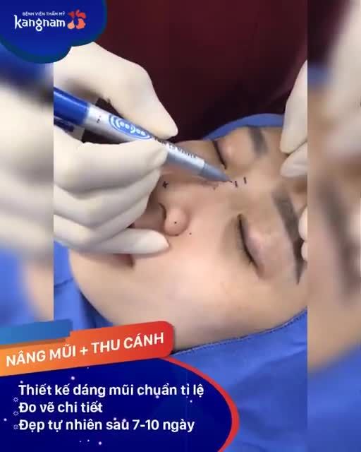 CÁNH MŨI TO BÈ - Giải pháp như thế nào?