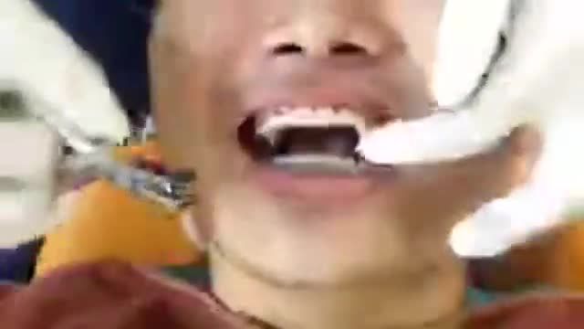 Bung lụa cho khách hàng răng Khớp Cắn Ngược - Thưa - Khấp khểnh