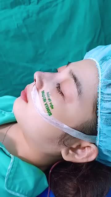 LỘT XÁC KHÓ TIN - XEM NGAY KẾT QUẢ NÂNG MŨI CẤU TRÚC FASCIA - TRẢ LẠI DÁNG MŨI HOÀN HẢO