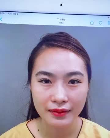 MÍ MẮT SAU 7 NGÀY SỬA MÍ TẠI DR.HẢI LÊ SẼ NHƯ THẾ NÀO?