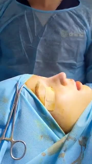 Ngắm nhìn hình ảnh nâng mũi ca thứ 8 tại trung tâm Bác sĩ Đỗ Quang Khải