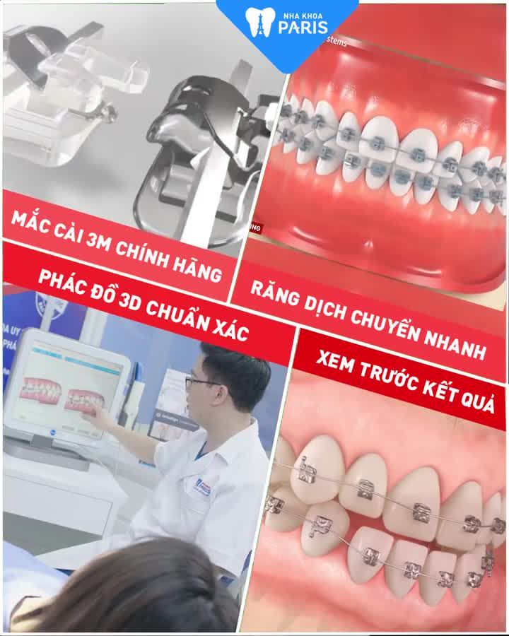 Niềng Răng Mắc Cài 3D Speed- Răng Đều Đẹp Khác Biệt Sau 6 Tháng