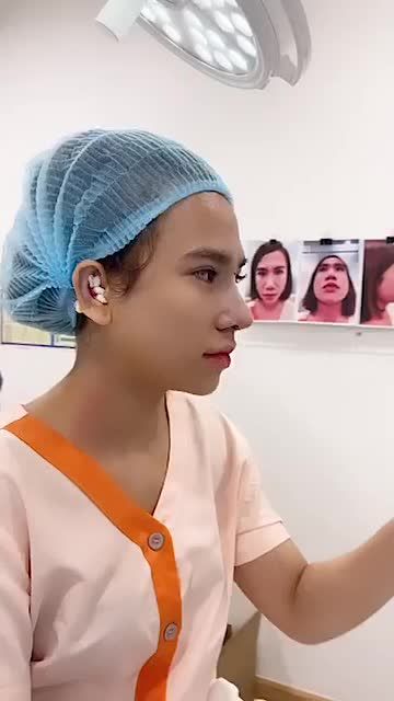 XỬ LÝ CA MŨI NGUYÊN THỦY THẤP GÃY, CÁNH MŨI TO