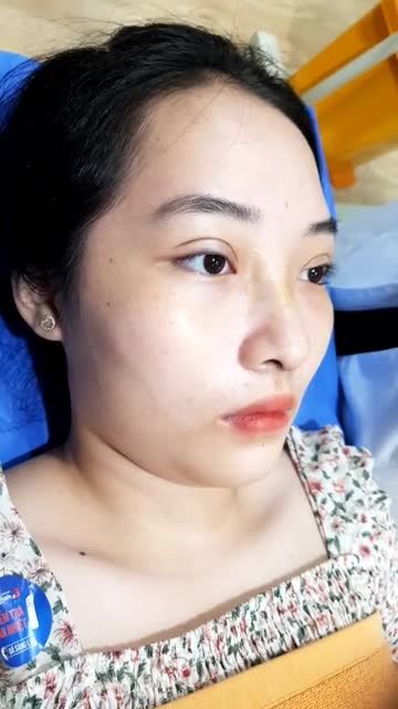KHÁCH HÀNG THỰC HIỆN DỊCH VỤ CẮT MÍ TRÊN PLASMA SAU 7 NGÀY.