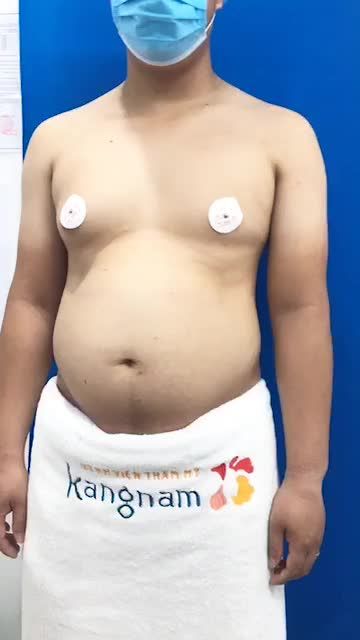 Bác sĩ Kangnam đo vẽ, phân tích cho khách hàng sử dụng Combo dịch vụ:.Giảm mỡ bụng .Tạo hình bụng 6 múi