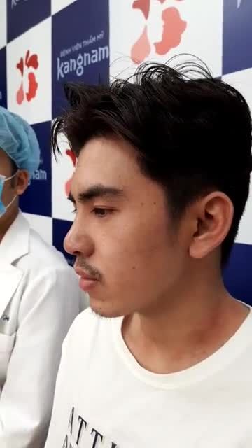 NÂNG MŨI CẤU TRÚC 4D DÁNG L - LINE - ĐẸP "CHUẨN" MEN