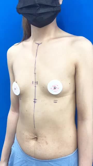 Quá trình đo vẽ chọn size túi ngực cho khách hàng trước khi thực hiện dịch vụ Nâng ngực Nano Chip Economix tại Kangnam.