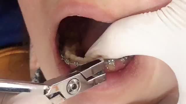 Bung lụa cho khách hàng răng Khấp khểnh 2 hàm - Khớp cắn sâu