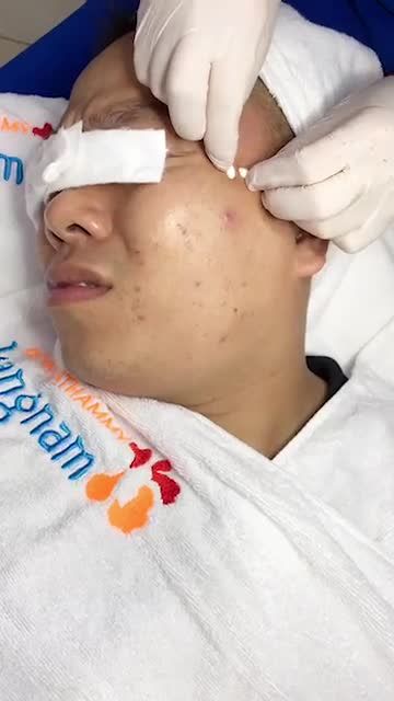 BẠN ĐÃ BIẾT? Điều trị mụn chỉ thực sự hiệu quả khi loại bỏ hết nhân mụn