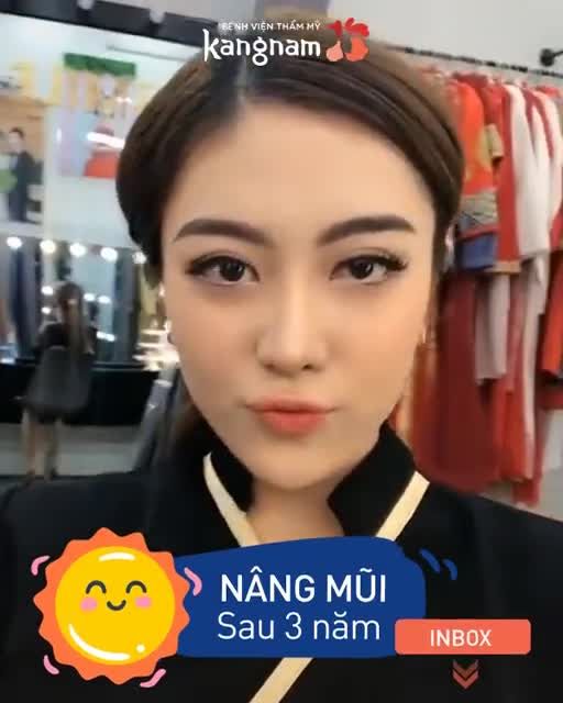 "Cực phẩm" NÂNG MŨI sau 3 năm