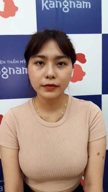 Hạnh phúc vỡ òa với kết quả nâng mũi sau 1 tháng của chị khách nhà Kangnam