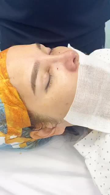 Ca nâng mũi cấu trúc vừa thực hiện xong tại DR KHẢI