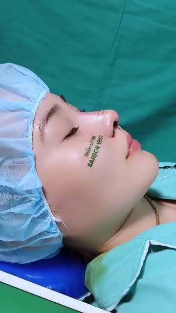 NÂNG MŨI CẤU TRÚC FASCIA ĐỘC QUYỀN TẠI SAIGONVENUS