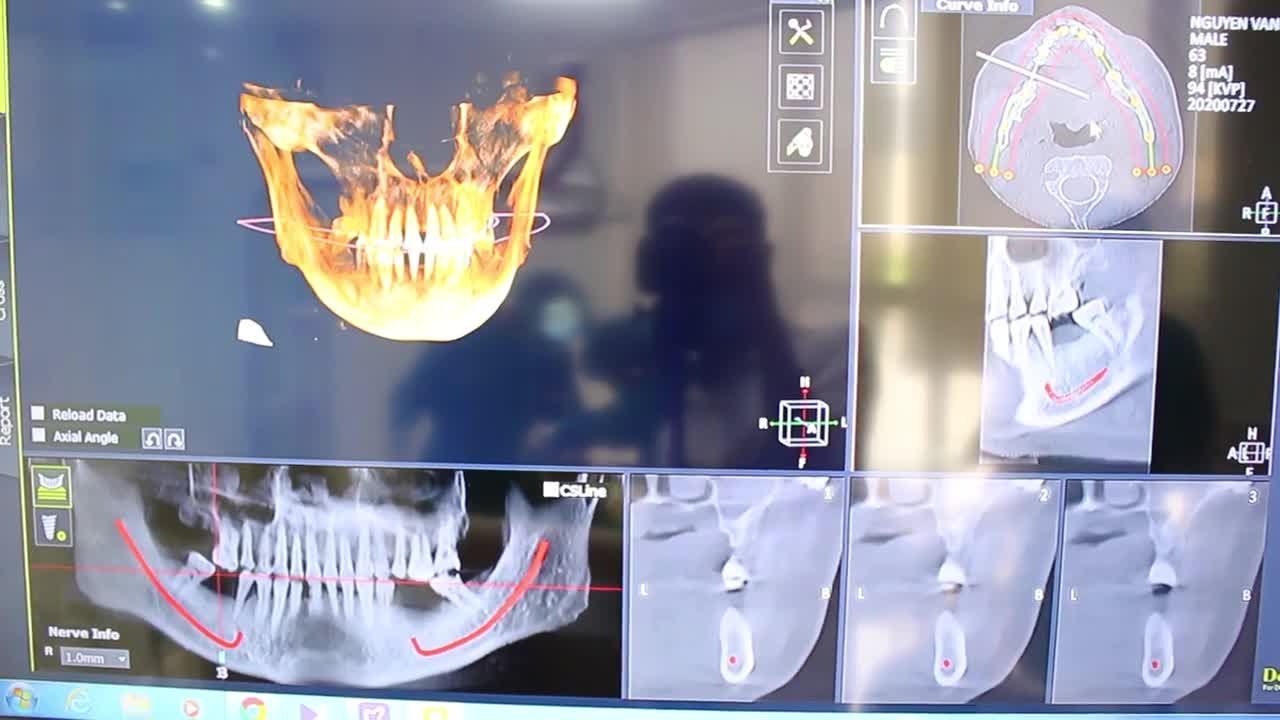 NHỮNG ĐIỀU CẦN LƯU Ý SAU CẤY IMPLANT