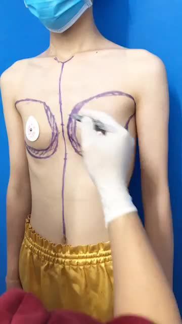 Cùng bác sĩ Kangnam đo vẽ và thiết kế dáng ngực mới cho chị khách hàng