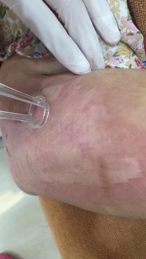 ĐIỀU TRỊ SẸO LỒI VỚI CÔNG NGHỆ ULTRAPULSE