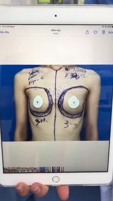 Kết quả ngay sau khi Nâng ngực kết hợp với Cấy mỡ tại Bệnh viện thẩm mỹ Kangnam.Xem ngay