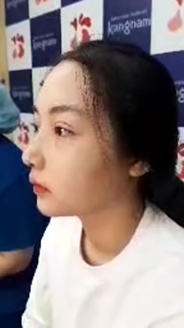 Khách hàng "Lột xác" ngoạn mục với Combo thần thánh Nâng mũi cấu trúc 4D và Cắt mí trên Plasma