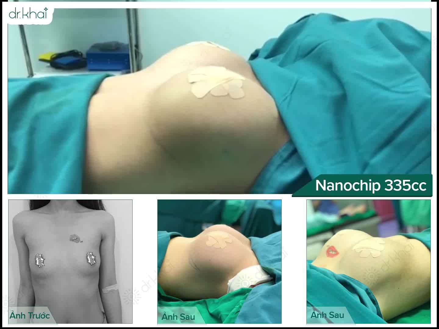 CHỌN SIZE TÚI NGỰC NHƯ THẾ NÀO LÀ PHÙ HỢP?