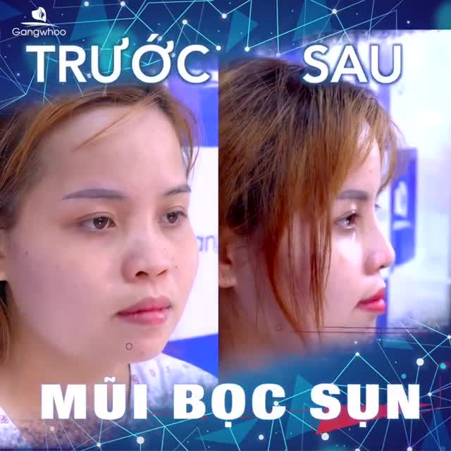 MŨI THẤP, ĐẦU MŨI NGẮN LÀM BẠN MẤT TỰ TIN?