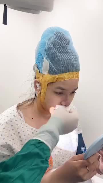 MŨI TO HÓA MŨI NHỎ SAU 90P NHẸ NHÀNG