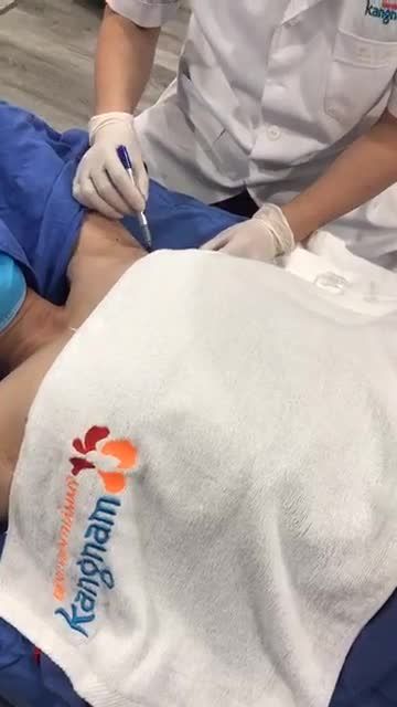 Hút tuyến mồ - điều trị hôi nách Endo Dry tại Kangnam